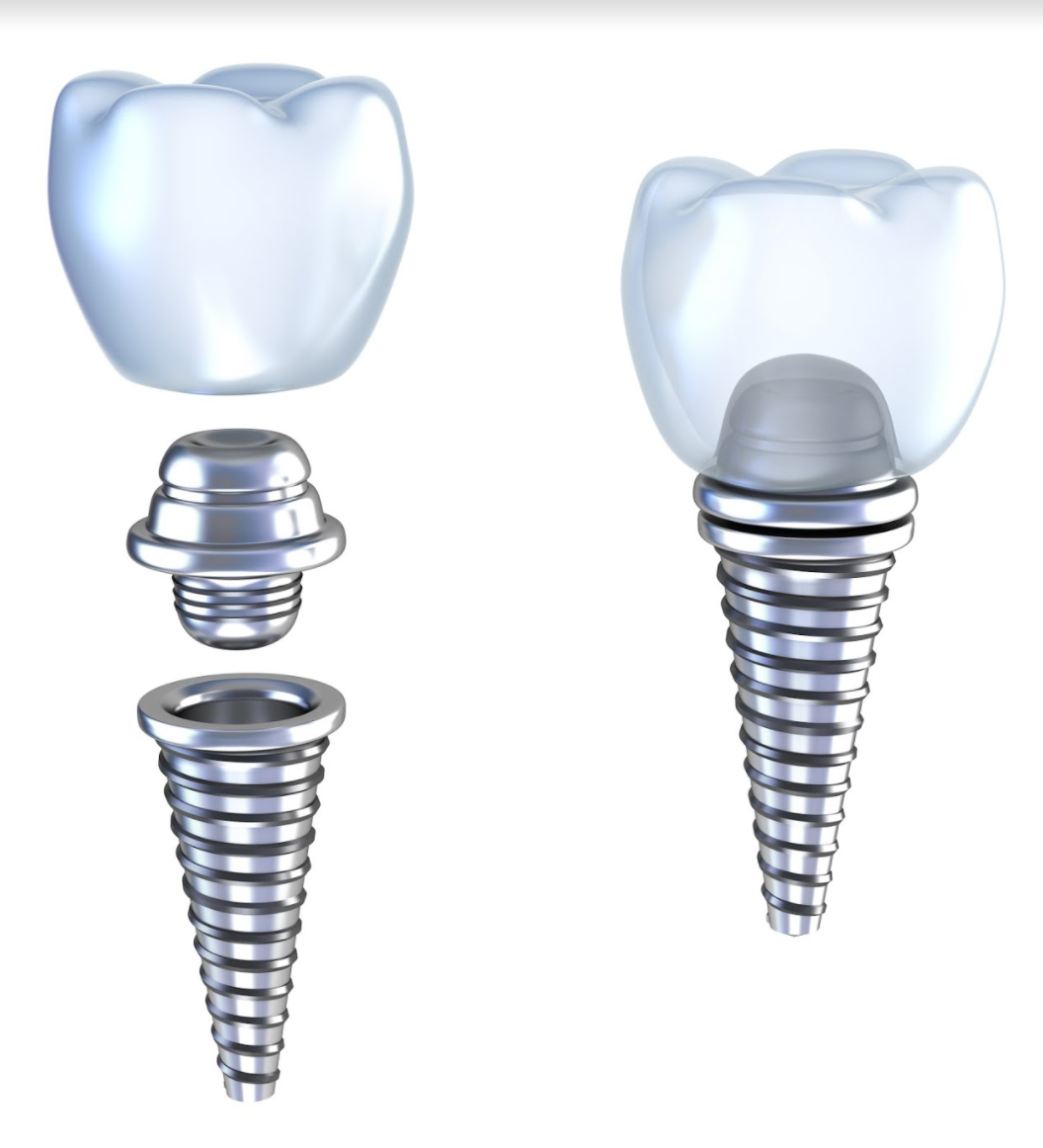 dental implants care
