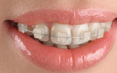 Impactful Implant Crowns: Restore Your Smile with Precision