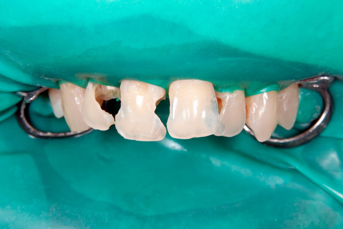 cracked tooth root canal