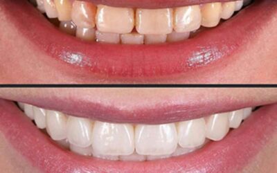 Find Dental Veneers Cost Near Me: Enhance Your Smile