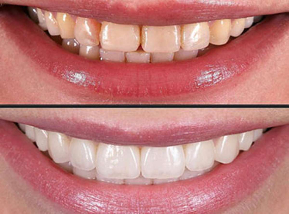 dental veneers cost near me