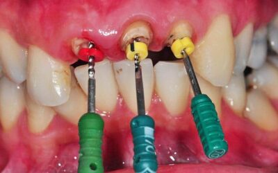 Root Canal Front Tooth: Expert Care for Radiant Smiles