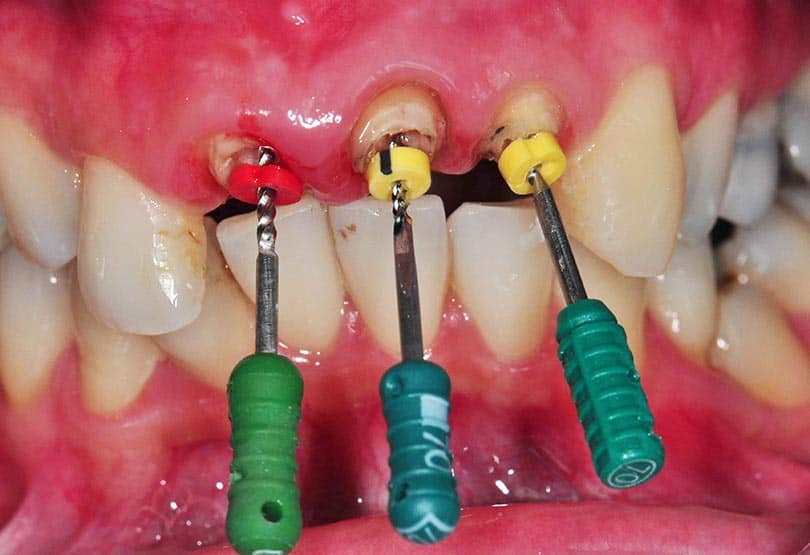 root canal front tooth