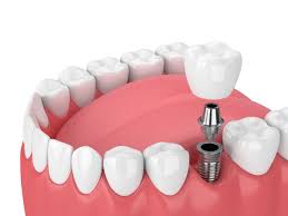 Affordable Dental Implants Cost: Quality Solutions