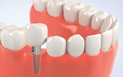 Low-Cost Dental Implants: Affordable Solutions for You
