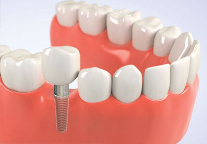 low cost dental implants low cost dental implants