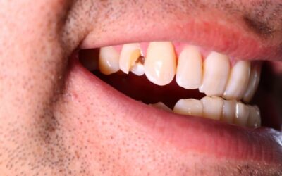 Swift Solutions for Broken Tooth: Emergency Dental Care