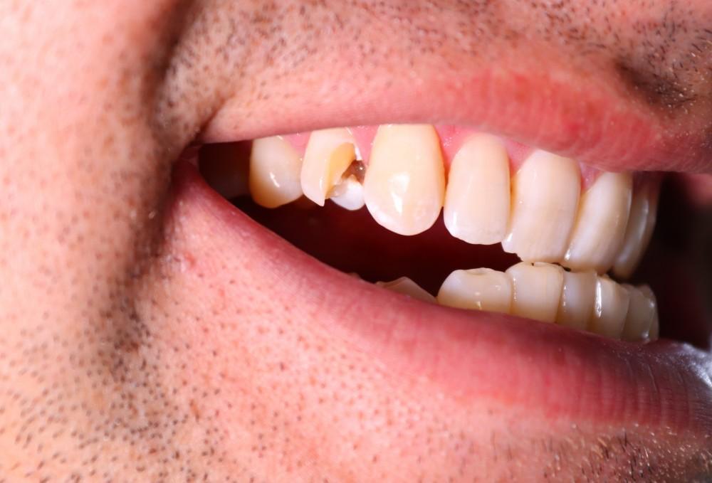 broken tooth pain broken tooth pain