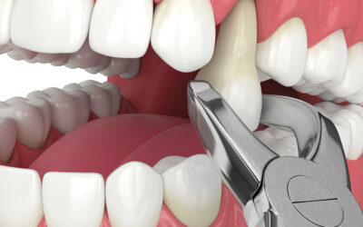 Immediate Relief: Emergency Dental Extraction Services