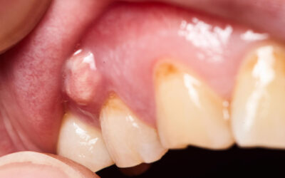 Don’t Ignore the Swelling: How Emergency Dentists Treat Abscessed Teeth