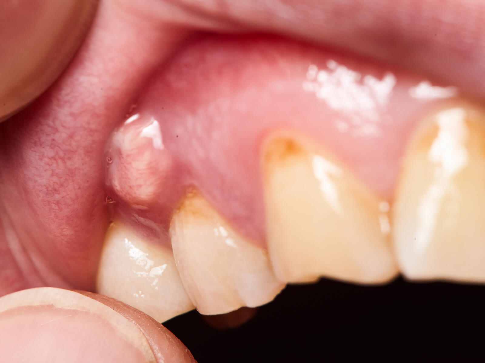abscess with teeth abscess with teeth