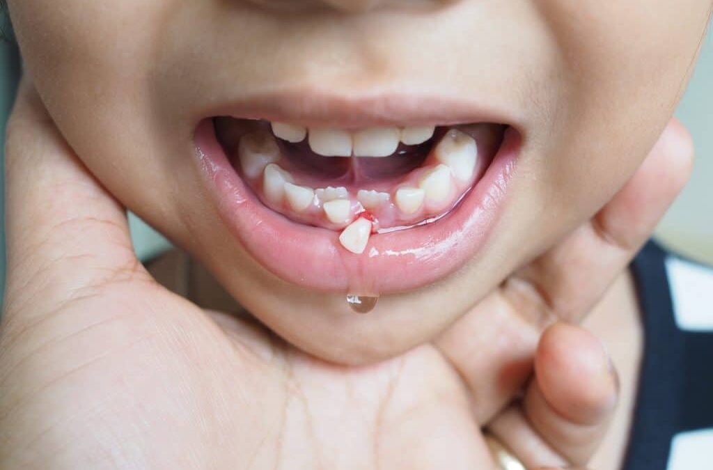 Knocked-Out Tooth? Here’s How to Save It Before It’s Too Late