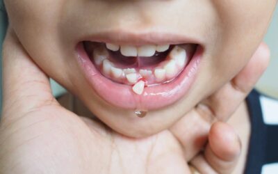 Knocked-Out Tooth? Here’s How to Save It Before It’s Too Late