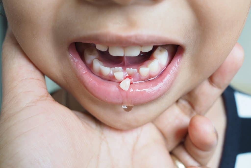 knocked out tooth knocked out tooth