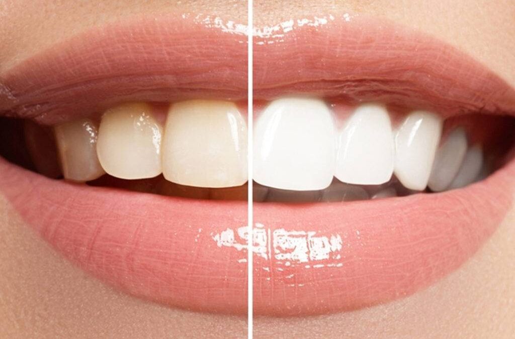 Teeth Bleaching Near Me: Brighten Your Smile Today