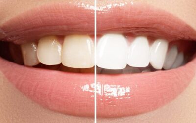 Teeth Bleaching Near Me: Brighten Your Smile Today