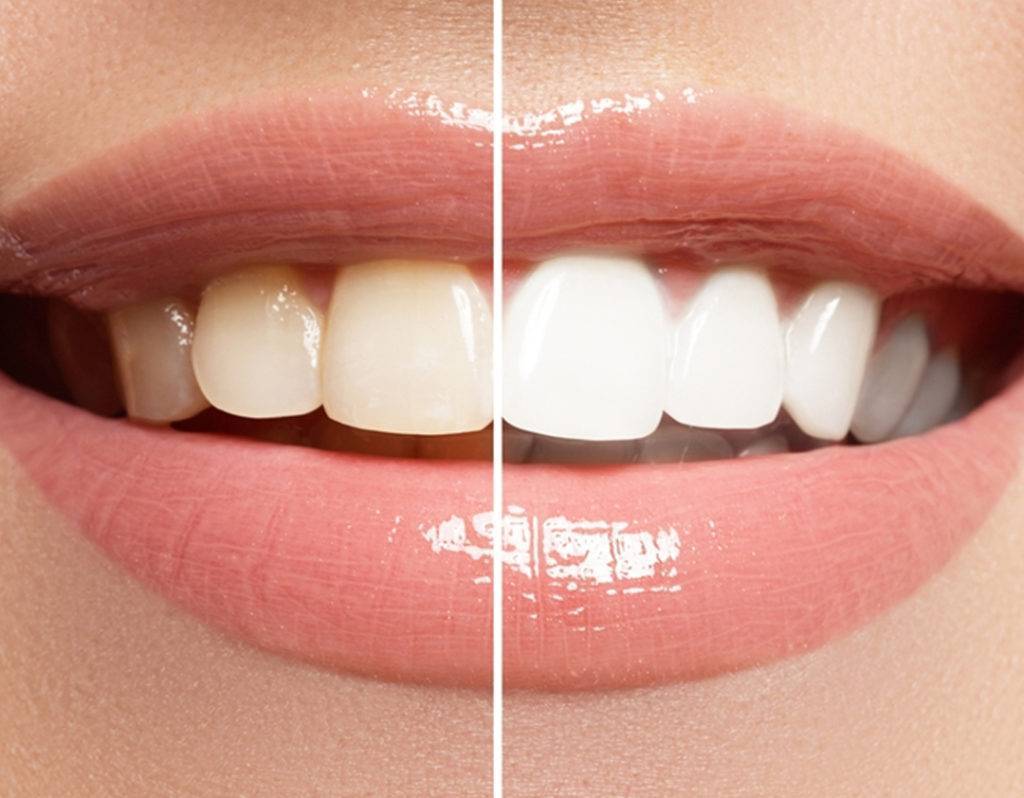 teeth bleaching near me