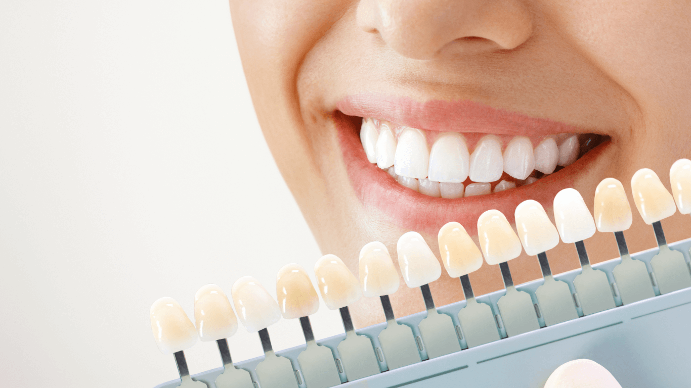 Dentist Charge for Teeth Whitening featured image Dentist Charge for Teeth Whitening featured image