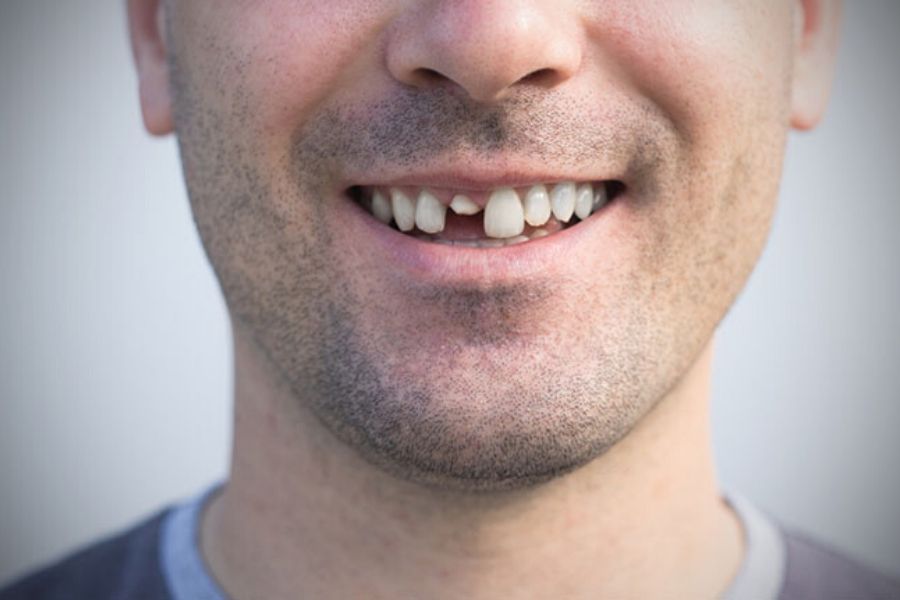 broken tooth pain relief featured image broken tooth pain relief featured image