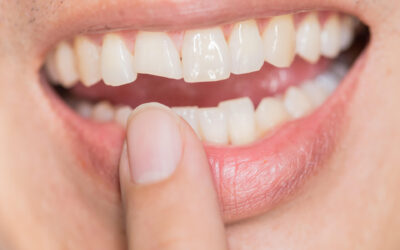 The Ultimate Guide to Finding Effective Treatment for Broken Tooth Pain