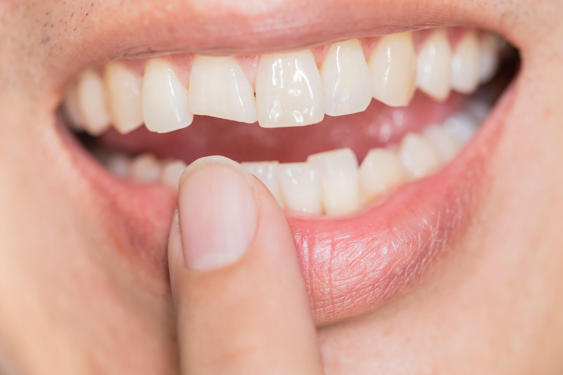 treatment for broken tooth pain featured image treatment for broken tooth pain featured image