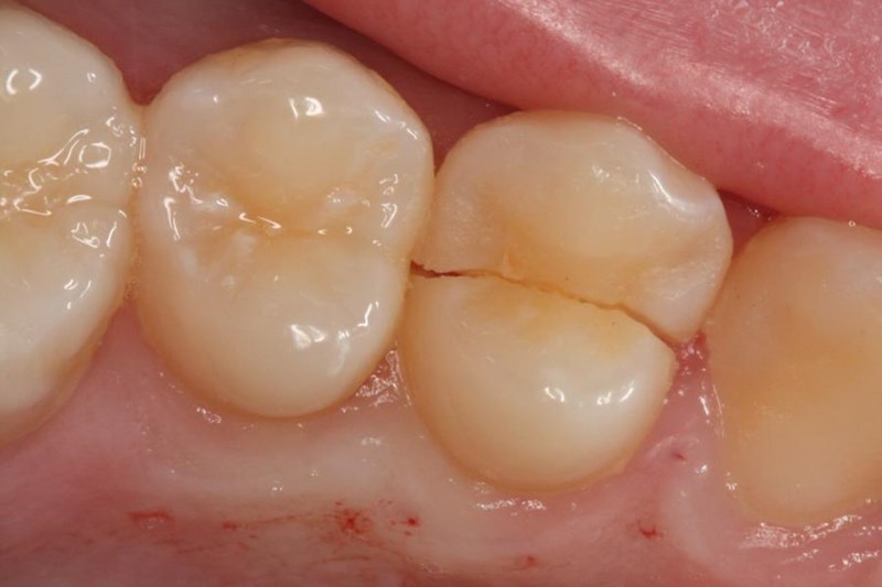 cracked tooth pain featured image