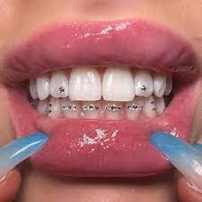 Tooth Gems: Add Sparkle to Your Smile Safely and Stylishly