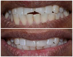 Broken Tooth Repair: Dental Bonding, Crowns & Veneer