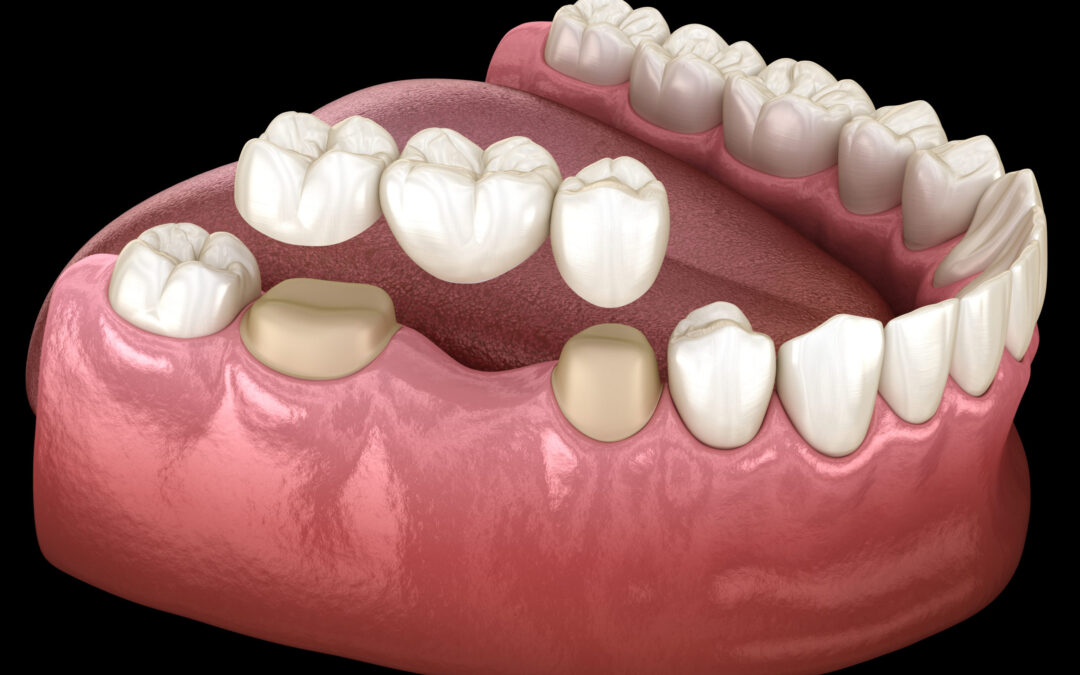 Crown for Teeth – Restore Your Smile with Expert Dentistry