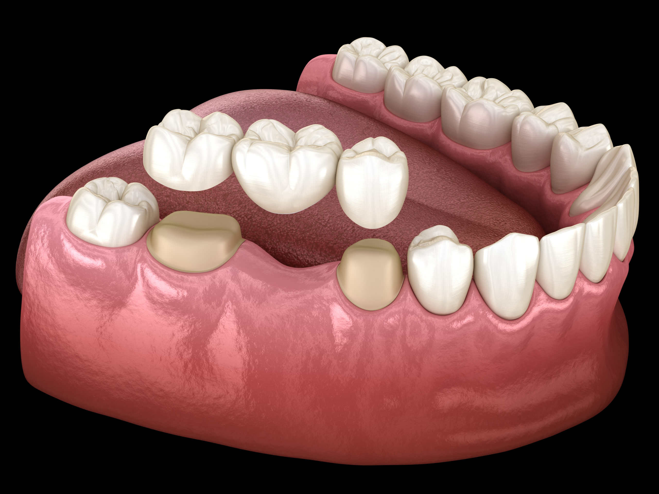 crown for teeth featured image