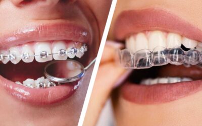 Invisalign Braces Pricing: Affordable Clear Aligners for Your Smile