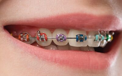 Traditional Metal Braces: Effective Treatment for Any Smile