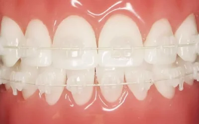 Braces Transparent Cost: Price, Benefits & What to Expect
