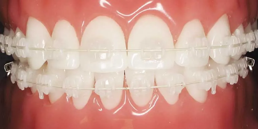 braces transparent cost featured image