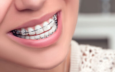 Ceramic Braces Dentist: Your Guide to Specialists & Treatment