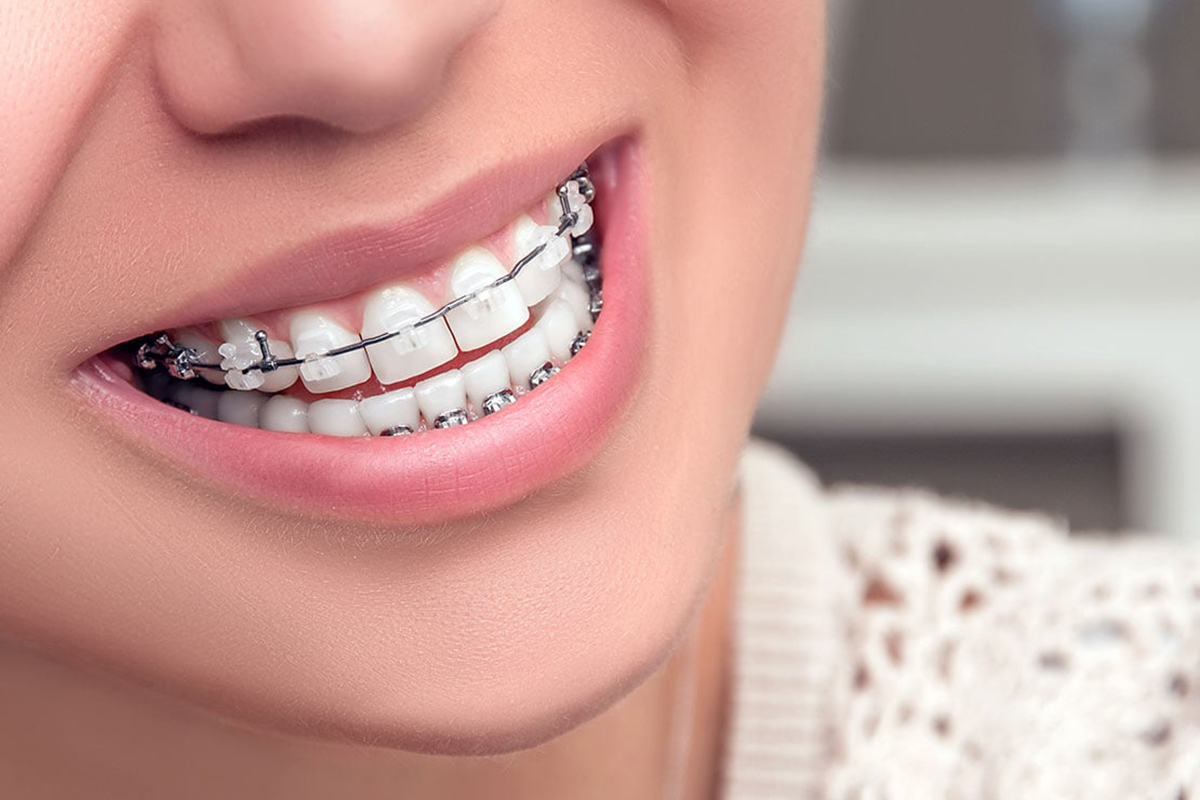 ceramic braces dentist featured image ceramic braces dentist featured image