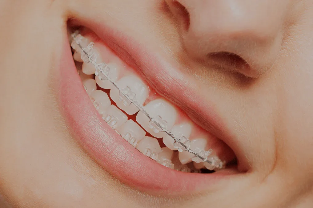 Ceramic Braces Cost: Average Price, Pros & Cons Explained
