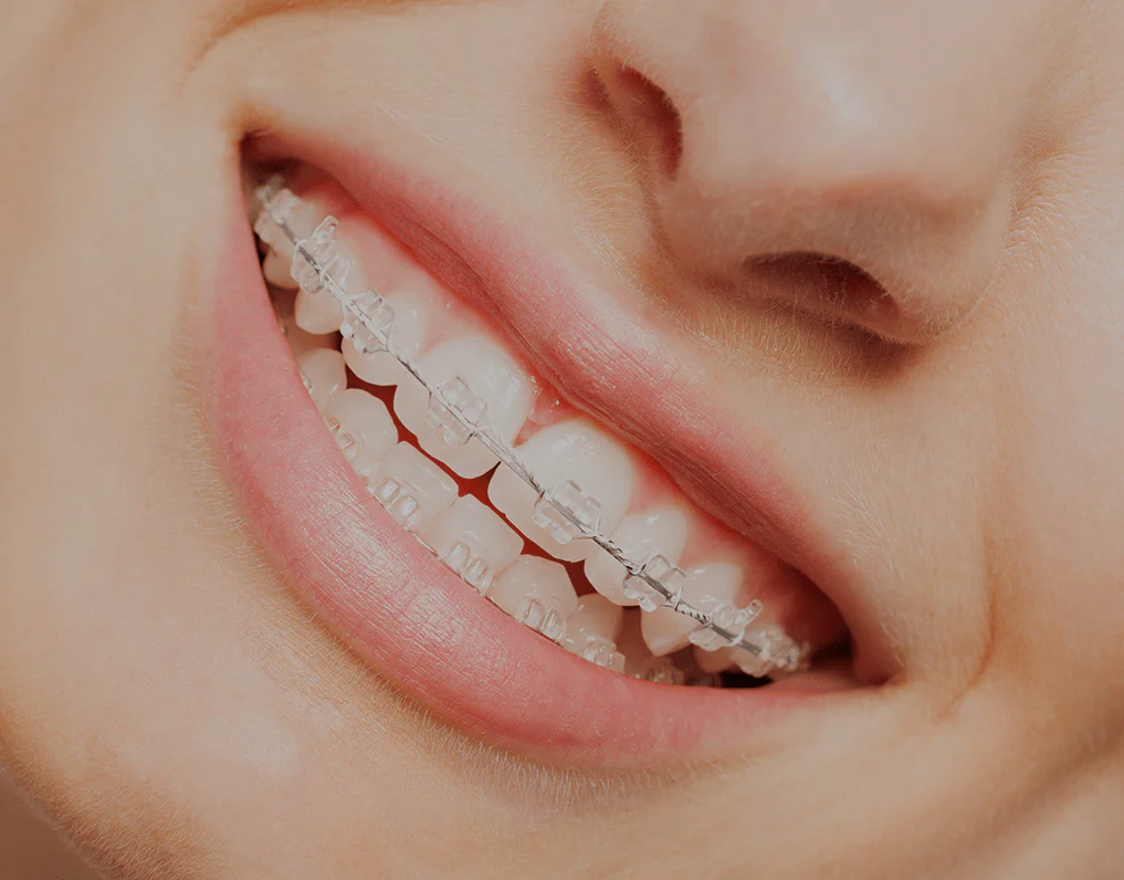 ceramic braces cost featured image