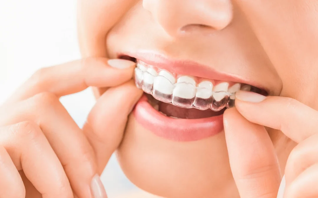 “Transparent Braces: Clear, Comfortable, and Effective Teeth Alignment”