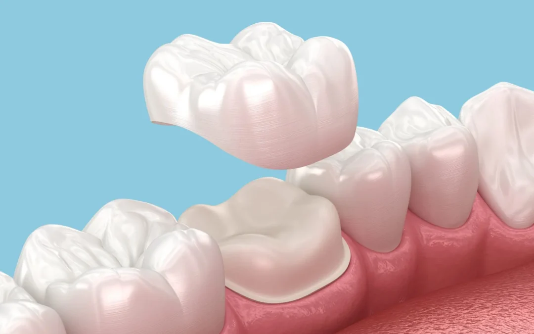 What Are Crowns for Teeth? Purpose, Types, and Dental Benefits