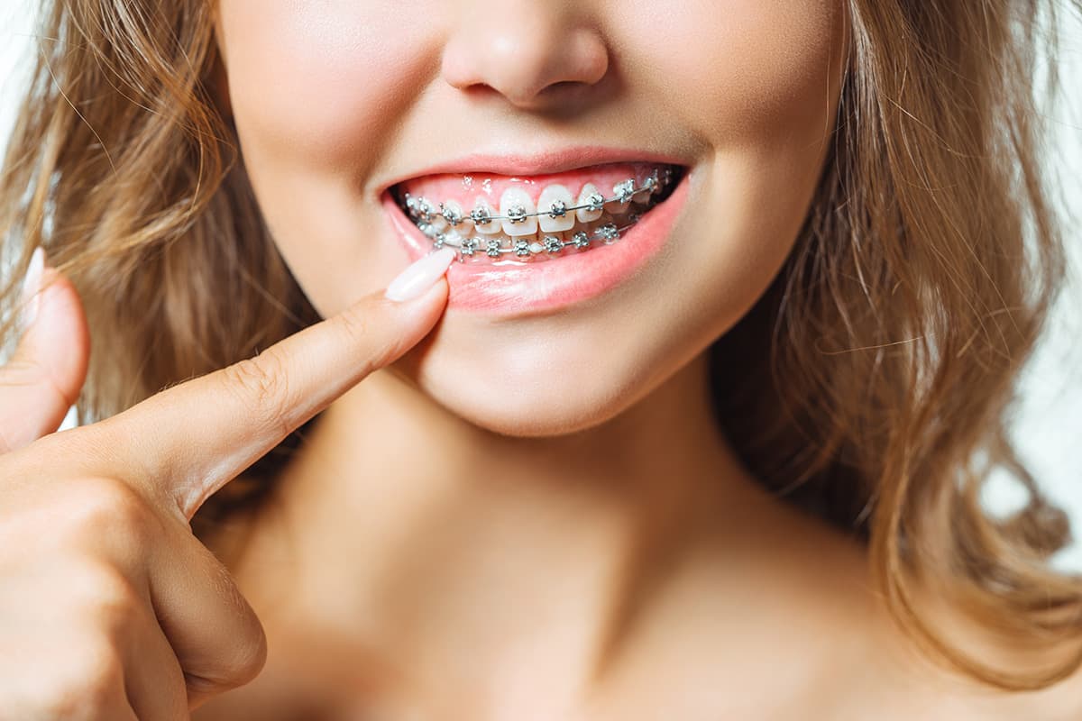 Braces for Adults featured image