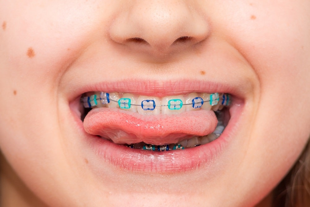 Braces for Children featured image