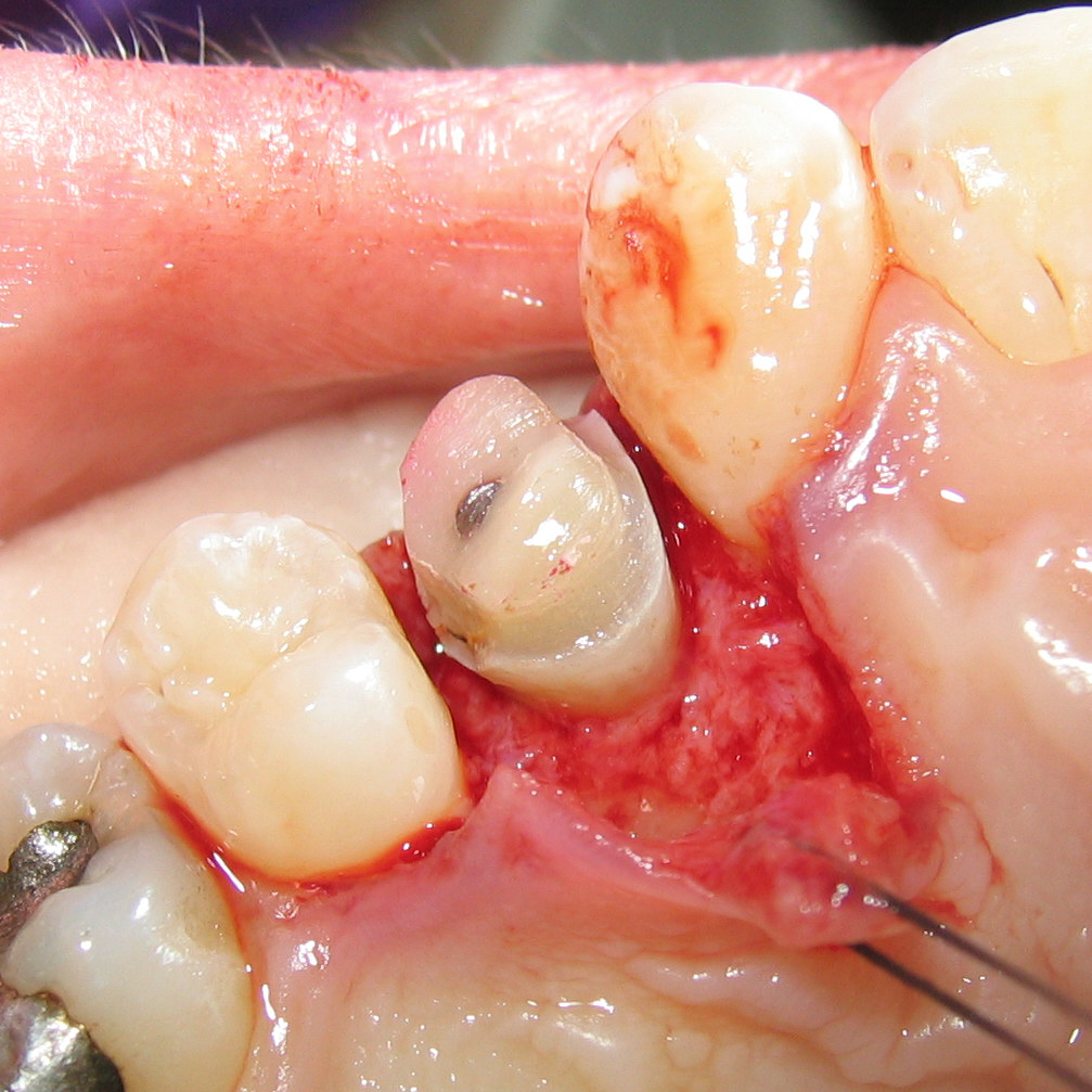 Crown Lengthening featured image