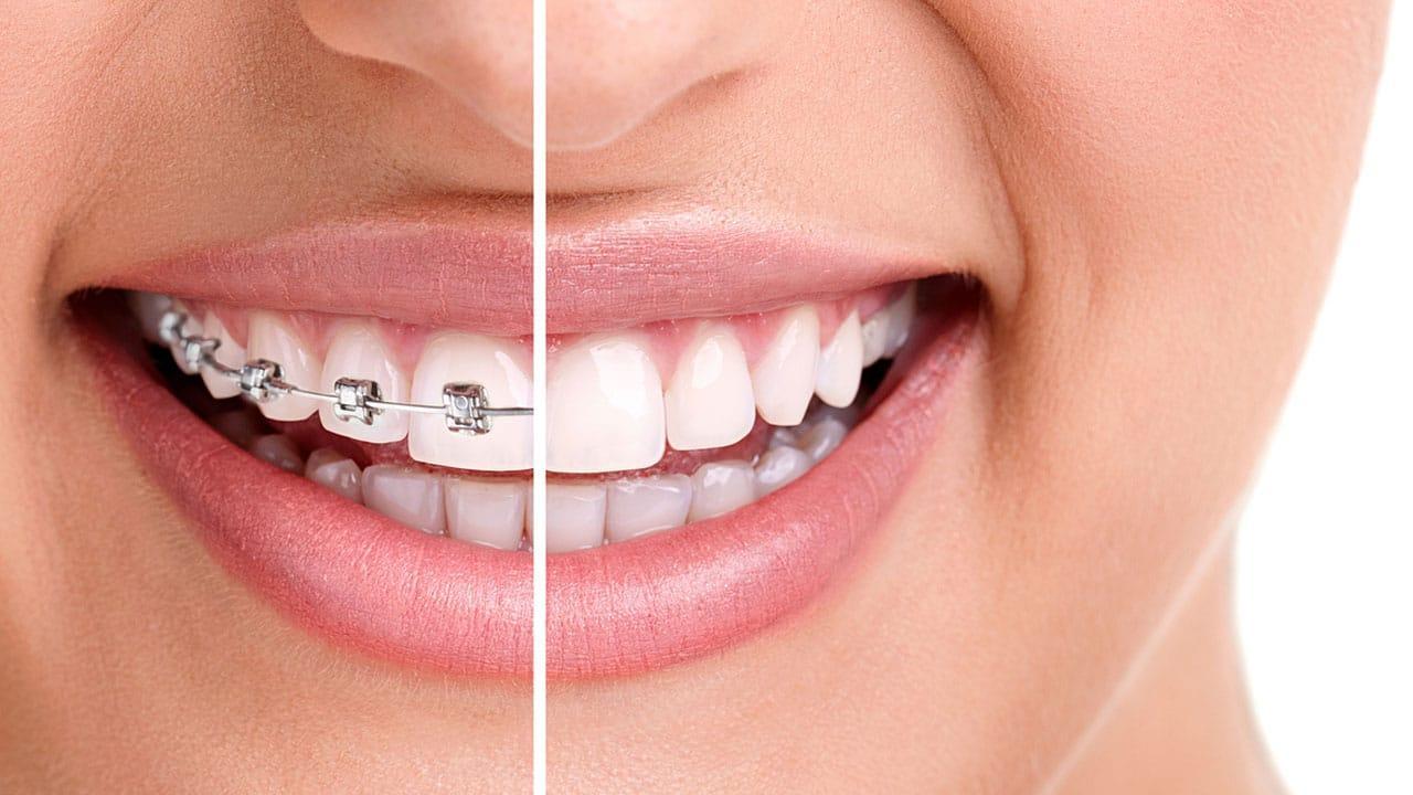 Orthodontic Treatment (Braces) featured image