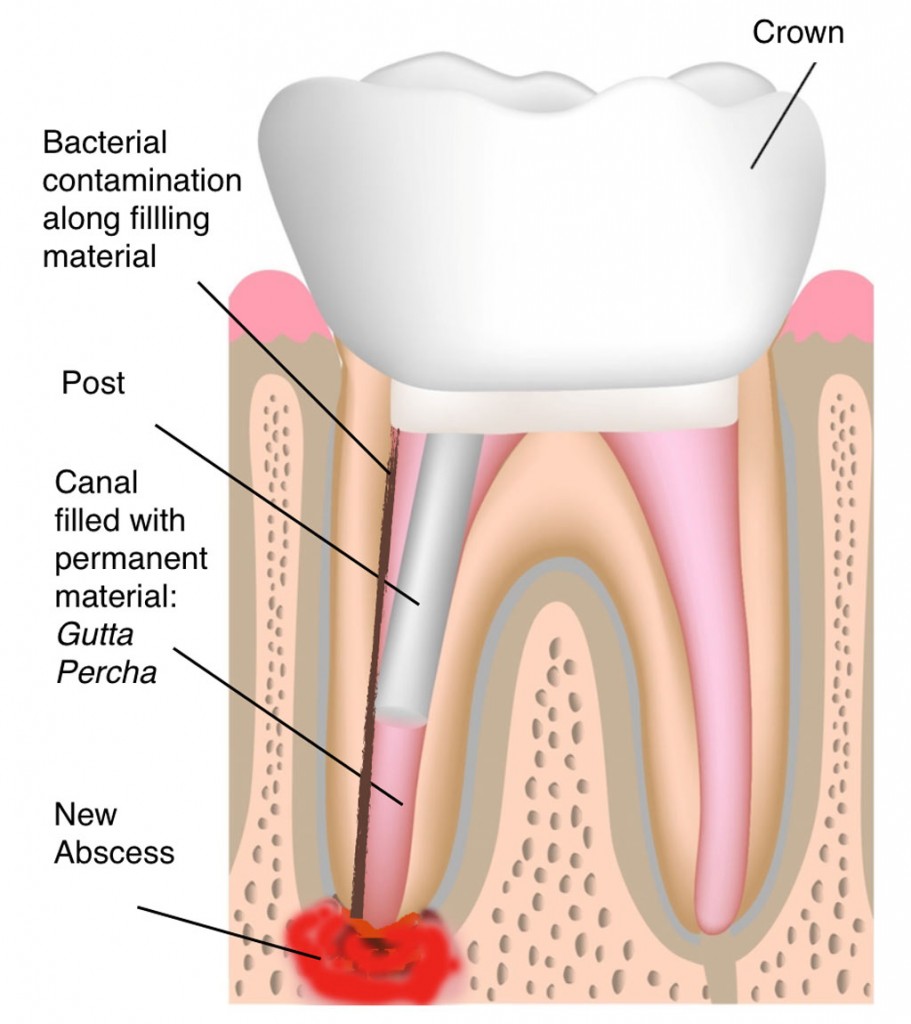 Root Canal Retreatment featured image