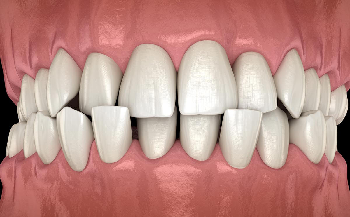 What is a Malocclusion featured image